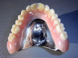 Complete Upper CoCr Denture