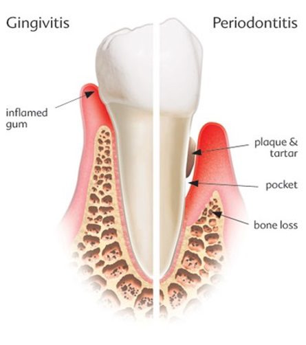 Picture showing the difference between gingivitis and periodontitis