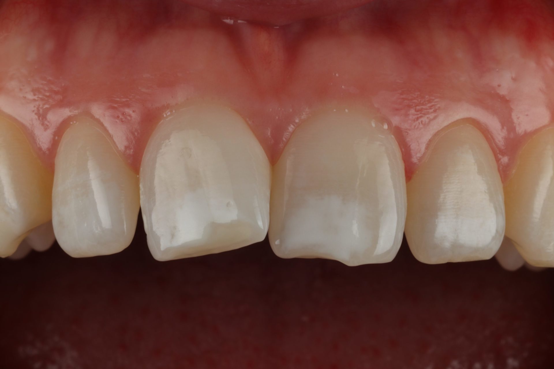 Before ICON Resin Infiltration