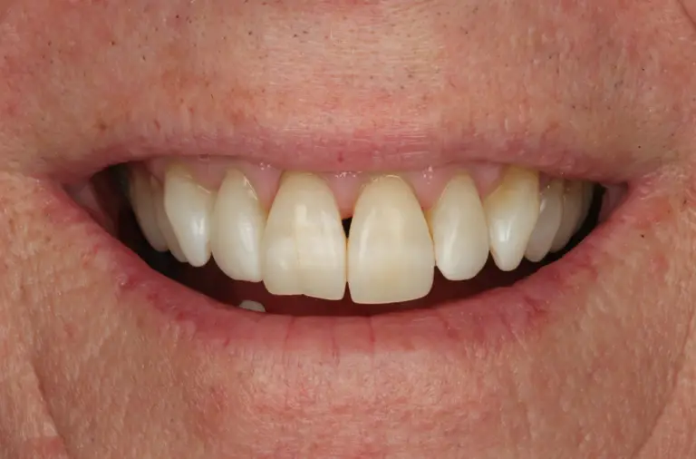 Teeth after whitening treatment