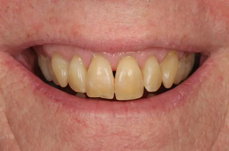 Teeth before whitening treatment